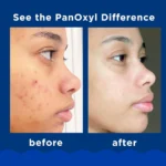 PanOxyl Acne Foaming Wash Benzoyl Peroxide 10% Maximum Strength - Image 4